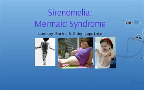 Mermaid Syndrome by Lindsay Barks on Prezi