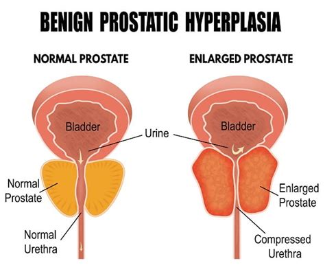 Benign Prostate Enlargement & Its Symptoms - DiseaseFix