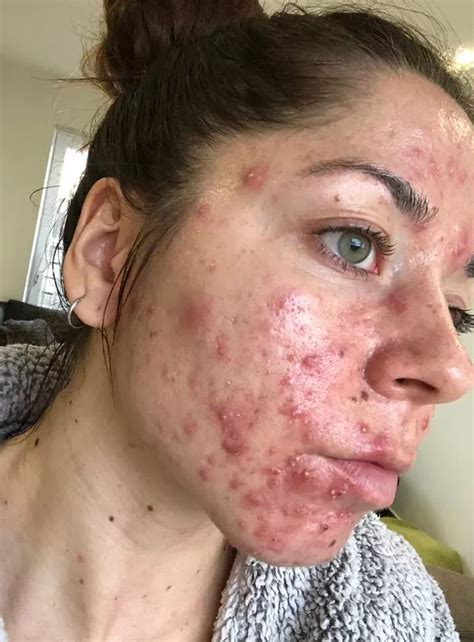 Woman, 25, has to quit job as boils erupt in 'worst case of acne' docs ...