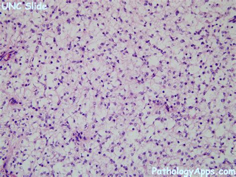 pilocytic astrocytoma pathology