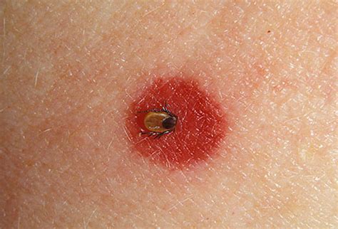 Healthy Life: Lyme Disease