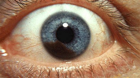 Eye Melanoma, Media Hype, and Genomic Medicine - DNA Science