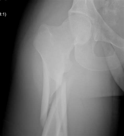 Subtrochanteric Fractures | The Bone School