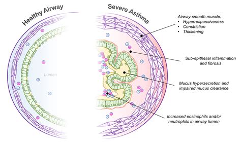 Severe Asthma Pathophysiology | Severe Asthma Toolkit