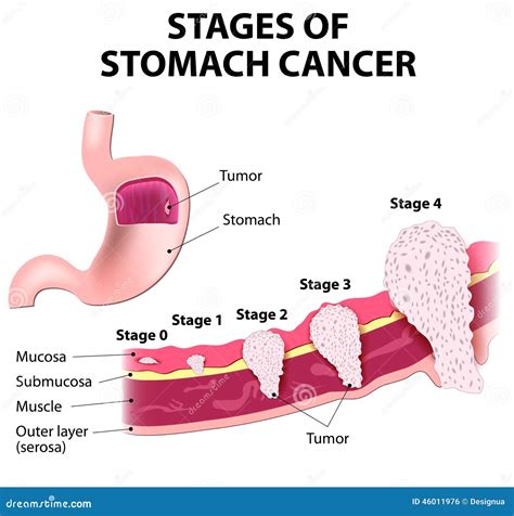 Staging of stomach cancer stock vector. Illustration of helicobacter ...