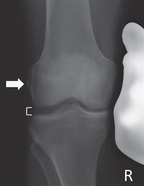 Comparative varus stress X-rays. (a and b) Patient case 1, at 14... | Download Scientific Diagram