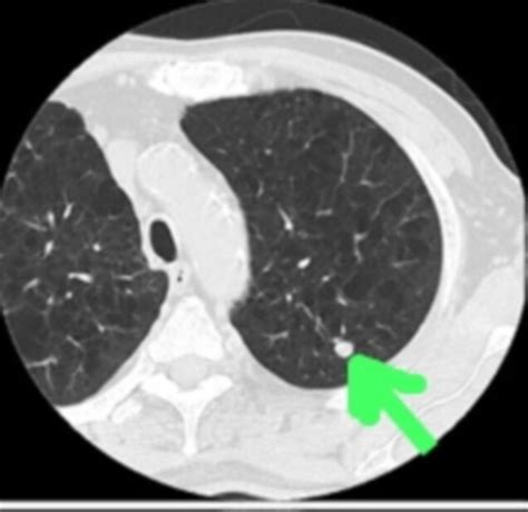 News Article: CT Scans for Lung Cancer Turn Up Few False-Positives ...