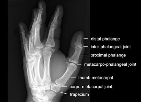 Thumb Proximal Phalanx Intra Articular Fractures App | My XXX Hot Girl