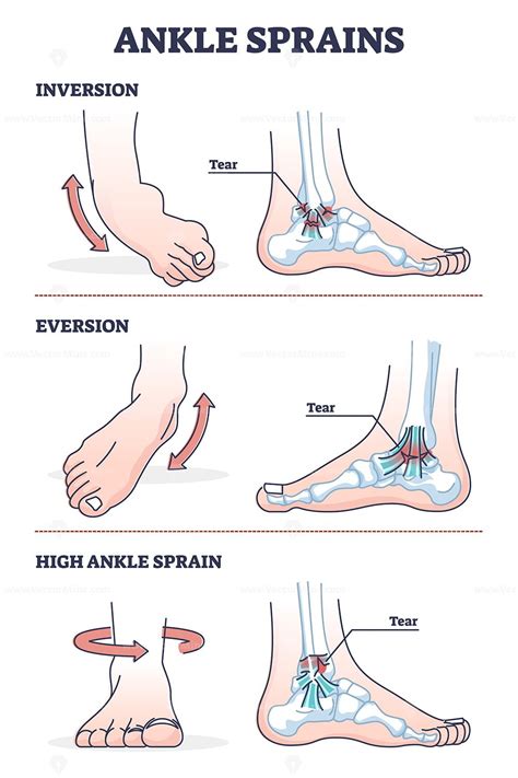 Ankle sprains situations with inversion and eversion injury outline diagram - VectorMine