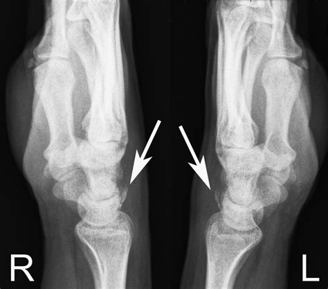 Simultaneous, bilateral fracture of the triquetral bone | BMJ Case Reports