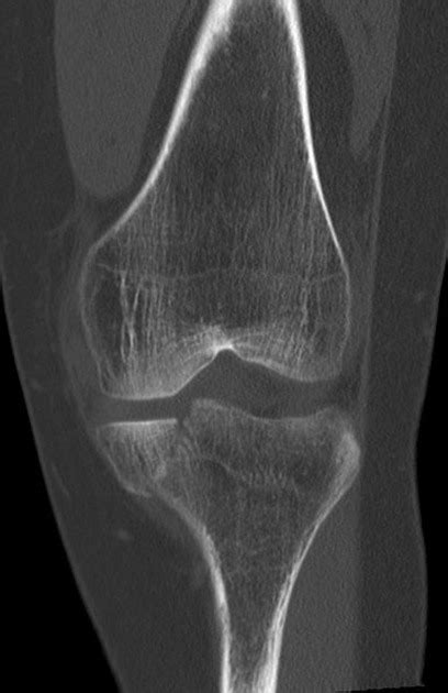 Tibial Plateau Fracture Xray