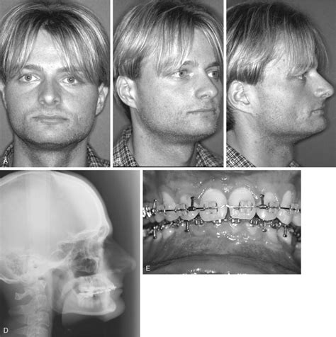 SAGITTAL SPLIT OSTEOTOMY | Pocket Dentistry