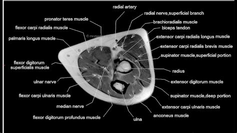 Sagittal Mri Elbow Anatomy