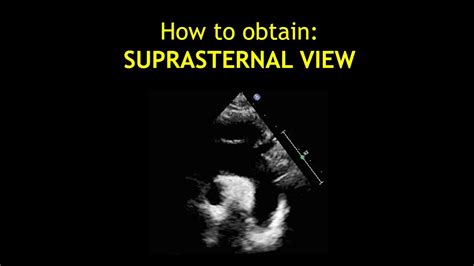 How to obtain: SUPRASTERNAL VIEW! (Echocardiogram) - YouTube