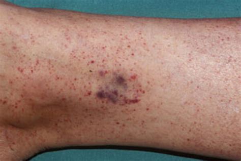 Petechiae - Pictures, Causes, Symptoms, Diagnosis and Treatment