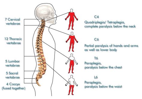 How bad does a spinal tap hurt: Lumbar puncture – NHS