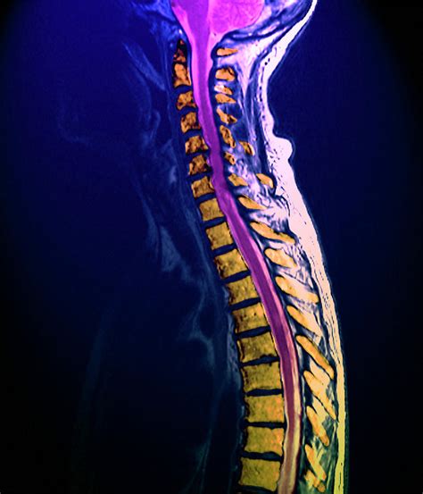 Arthritis Of The Spine Photograph by Zephyr/science Photo Library - Pixels