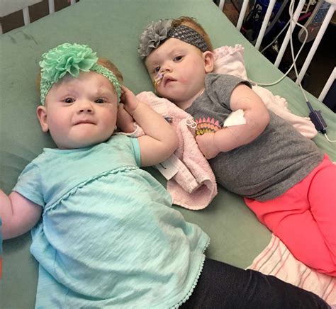 Formerly Conjoined Twins Thriving Five Months After Surgery