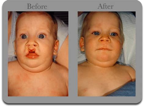 Cleft Lip Palate Surgery Service, Medical Surgery Services - Medispa Laser & Cosmetic Surgery ...