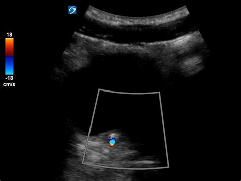 Renal colic - the twinkle artifact - Critical Care Sonography