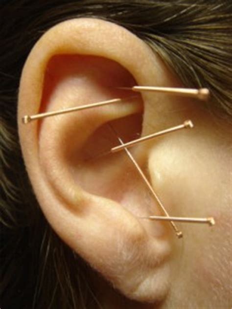 Auricular / Ear Acupuncture for PTSD, Smoking, Addiction, & Weight Loss – Acupuncture Arts Hawaii