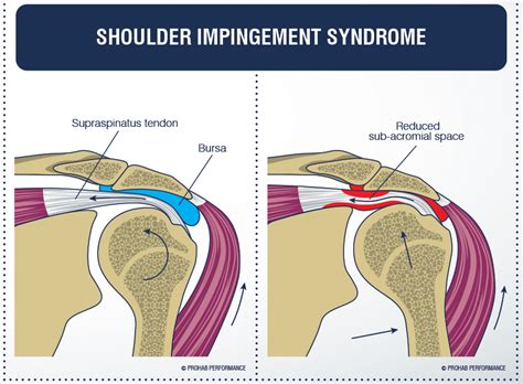 Shoulder Impingement Syndrome - Manor Chiropractic