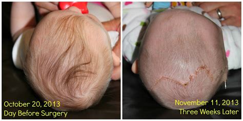 Leah's Right Coronal Craniosynostosis: Three Weeks Post-Op Progress