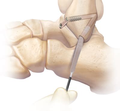 Arthrex - Lateral Ankle Ligament Reconstruction