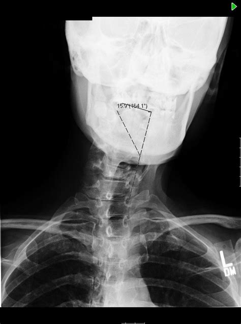 54 yo woman with neuromuscular condition and cervical scoliosis measuring 16 degrees and ...