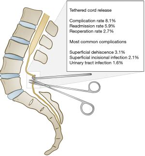 Pediatric tethered cord release: an epidemiological and postoperative ...