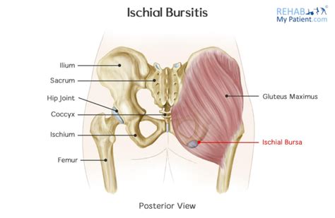 Ischial Bursitis Dubai