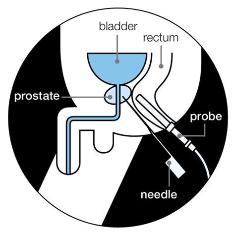 What is prostate Biopsy - Help a Father Foundation