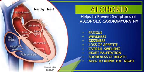 Alcoholic Cardiomyopathy: Long-term Effect, Symptoms, Treat