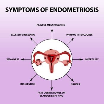 How Do I Know If I Have Endometriosis – Telegraph