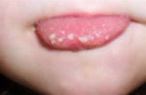 painful tongue bumps - pictures, photos