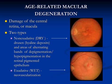 PPT - AGE-RELATED MACULAR DEGENERATION PowerPoint Presentation, free download - ID:976349