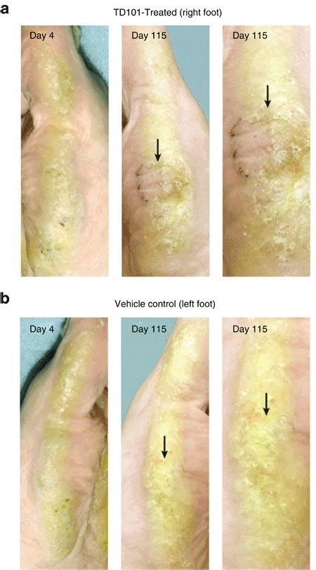 Improvement of pachyonychia congenita symptoms following TD101 ...