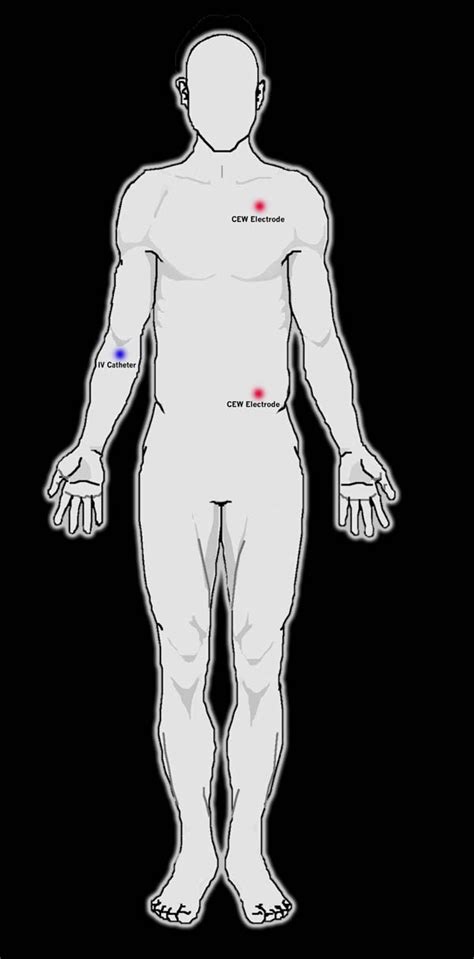 TASER Injuries | Semantic Scholar