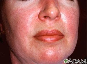 Dermatomyositis - heliotrope rash on the face: MedlinePlus Medical Encyclopedia Image