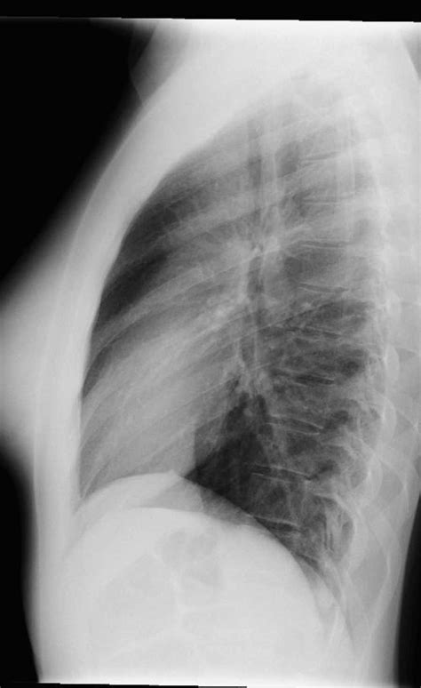 Normal Chest X Ray X Rays Case Studies Ctisus Ct Scanning | Images and ...