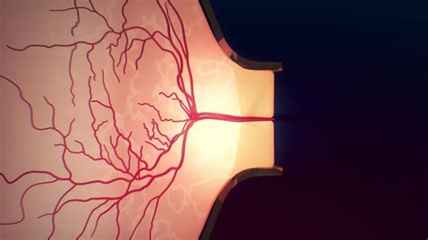 Overview of Optic Nerve Disorders - Eye Disorders - Merck Manuals ...