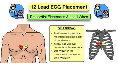 12 Lead ECG Placement: Diagram and Mnemonic for Limb and Precordial Electrode Location — EZmed