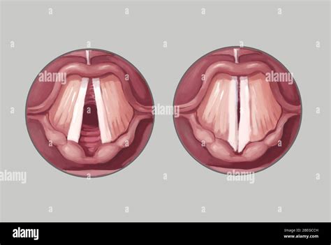 Vocal Cords Diagram