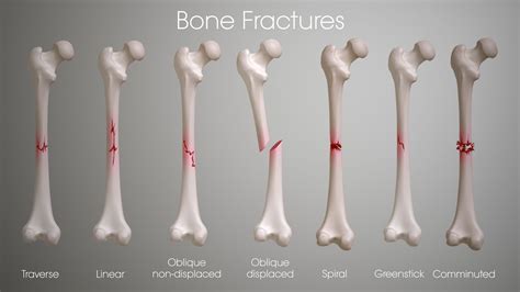 MEDICAL SCHOOL: Fracture types , Plaster Of Paris techniques and C... | Bone fracture, Fractures ...