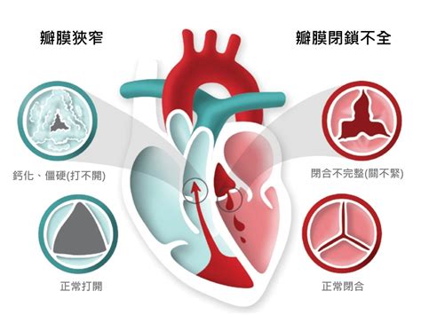 心臟瓣膜疾病 | 臺北榮總心臟瓣膜治療團隊|民眾衛教專區