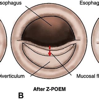 Traditional flexible endoscopic cricopharyngeal myotomy. A, The septum ...