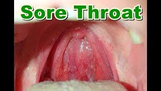 What Does A Normal Healthy Throat Look Like