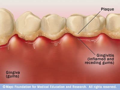 Signs and symptoms that requires immediate gingivi: Signs and symptoms ...