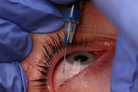 Latest eye injection proposals draw sharp rebuke from ophthalmology ...