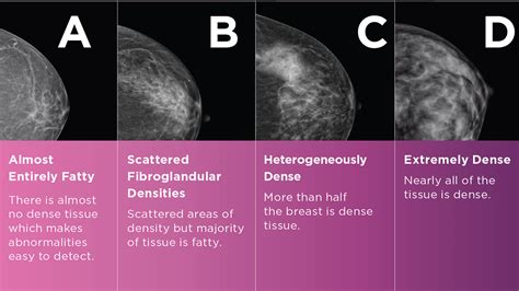 ¿QUÉ SON LOS SENOS DENSES? - Diagnóstico de Mayfair